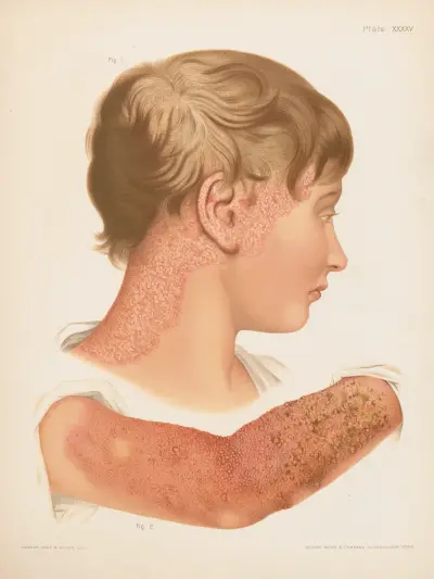 I. Eczema squamosum, II. Eczema papulosum, vesiculosum et impetiginosum, Prince Albert Morrow