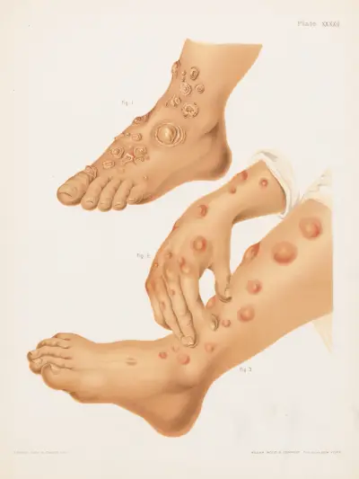 I. Herpes iris et circinatus, II. i III. Erythema nodosum., Prince Albert Morrow
