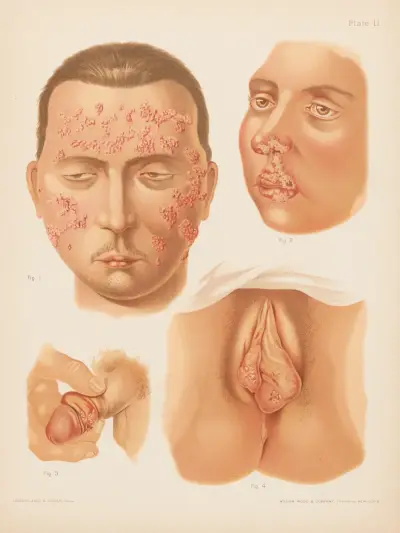 I. Herpes zoster (podwójny), II. Herpes febrilis, III. Herpes na męskich narządach płciowych, IV. Herpes na żeńskich narządach płciowych, Prince Albert Morrow