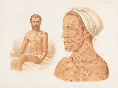 I. Pemphigus vulgaris, II. Pemphigus foliaceus, Prince Albert Morrow