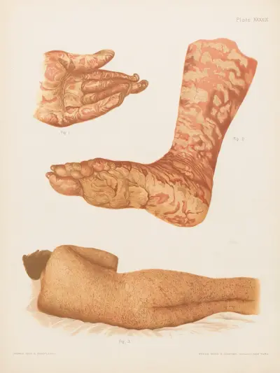 I. Pityriasis rubra nogi i podeszwy, II. Pityriasis rubra dłoni i paznokci, III. Zapalenie złuszczające skóry, Prince Albert Morrow