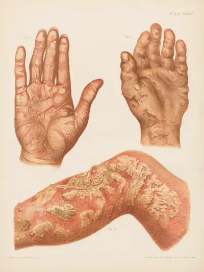 I. Psoriasis diffusa dłoni, II. Wyprysk dłoni, III. Eczema rubrum podudzia, Prince Albert Morrow