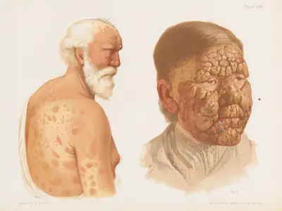 I. Tubercular Leprosy showing Macular Lesions, II. Tubercular Leprosy av Prince Albert Morrow