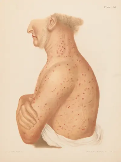 Pediculosis Corporis av Prince Albert Morrow