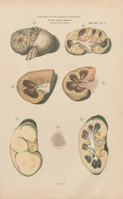 Chronic diffuse nephritis (Granular kidney) av Jean Allard Jeancon
