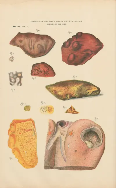 Cirrhosis of the liver,- infiltrations av Jean Allard Jeancon