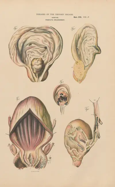 Cystitis and prostatic enlargement. Prostatic calculus. Vesical phlibitis av Jean Allard Jeancon