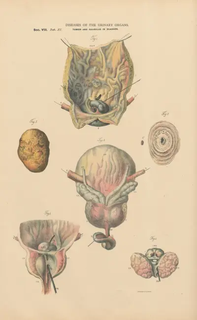 Cystitis. Tumor and uric acid calculus in the bladder av Jean Allard Jeancon