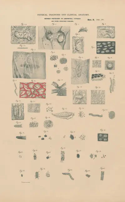 Morbid histology of abdominal typhoid, scarlet fever. Tuberculosis, Gangrene &c. av Jean Allard Jeancon