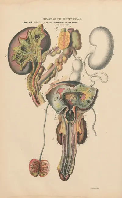 Nephritic tuberculosis with ulceration and inflammation of all urinary organs av Jean Allard Jeancon