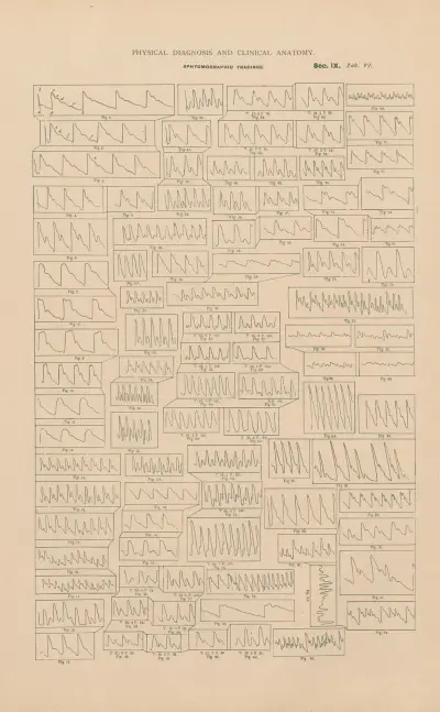 Sphygmographic tracings av Jean Allard Jeancon