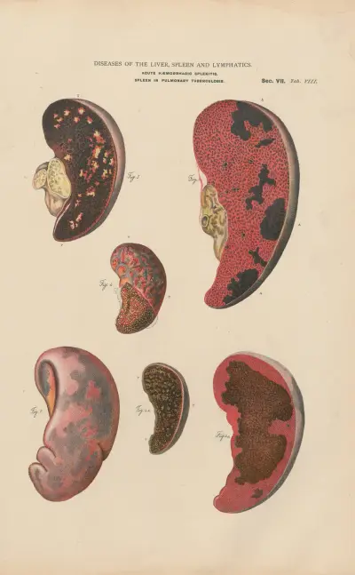Splenitis and infarct, with abcesses av Jean Allard Jeancon