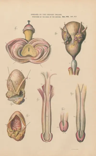 Tuberculous degeneration of prostate av Jean Allard Jeancon