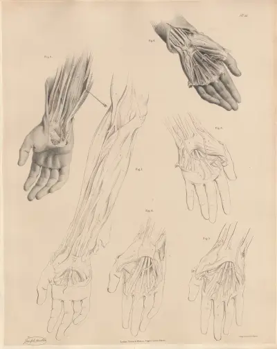 A rare form of Median artery, A peculiar muscle connected with the Ulnar artery, Joseph Maclise