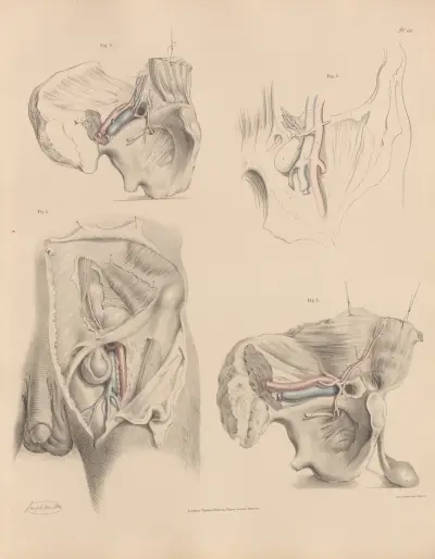The various relations of the Obturator artery to different kinds of hernia, Joseph Maclise