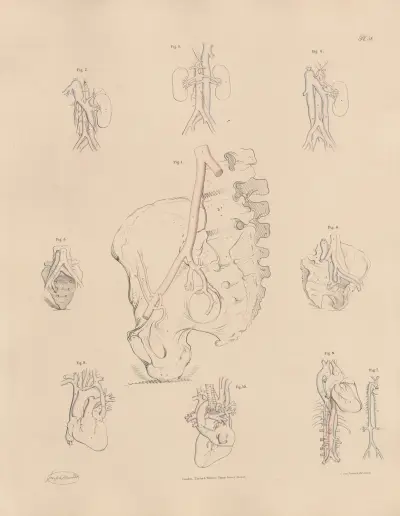 Unusual conformation of the Iliac arteries, Joseph Maclise