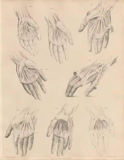 Various conditions of the arteries of the hand, Joseph Maclise