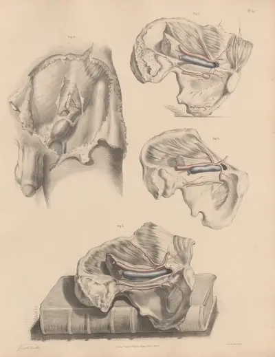 Various conditions of the Obturator artery, The Epigastric in connexion with a hernia, Joseph Maclise