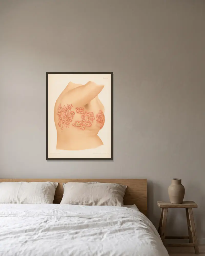 Herpes zoster von Prince Albert Morrow gerahmt an einer Wand