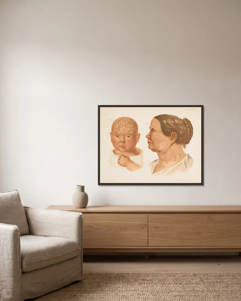 I. Ekzem der Kopfhaut, II. Ekzem des Gesichts von Prince Albert Morrow gerahmt an einer Wand