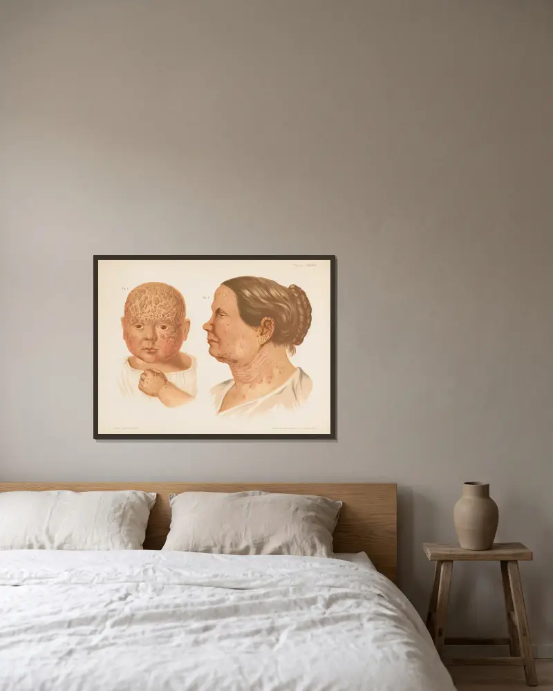 I. Ekzem der Kopfhaut, II. Ekzem des Gesichts von Prince Albert Morrow gerahmt an einer Wand