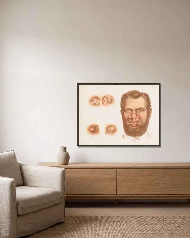 I., II. och III. Xantelasma, IV. Rhinosklerom av Prince Albert Morrow inramad på en vägg