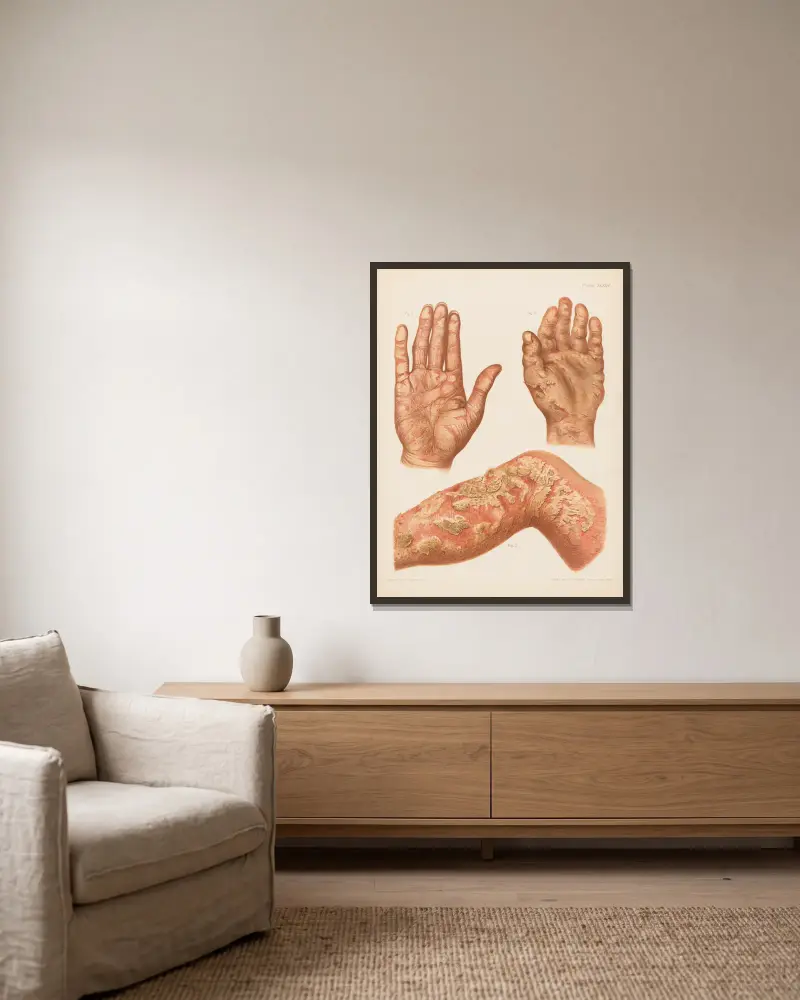 I. Psoriasis diffusa der Handfläche, II. Ekzem der Handfläche, III. Eczema rubrum des Beins von Prince Albert Morrow gerahmt an einer Wand