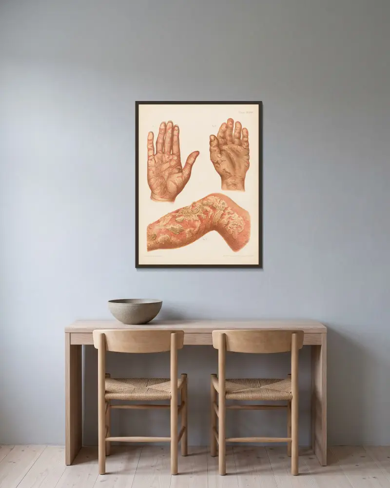 I. Psoriasis diffusa der Handfläche, II. Ekzem der Handfläche, III. Eczema rubrum des Beins von Prince Albert Morrow gerahmt an einer Wand