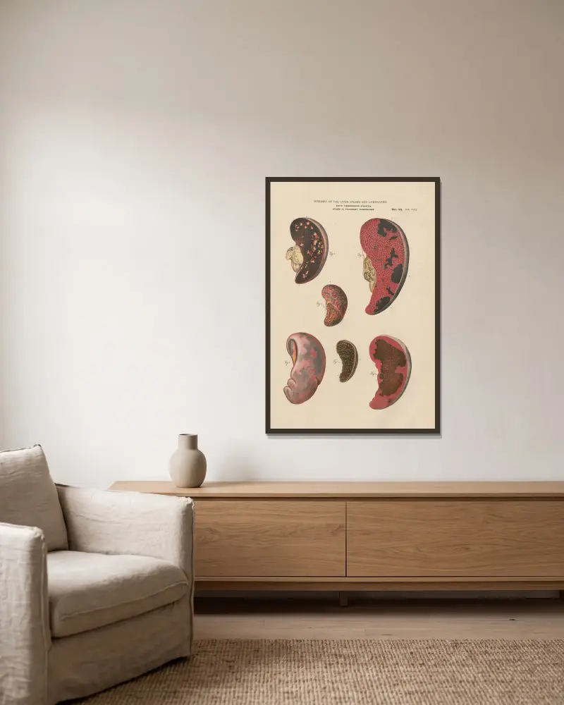 Milzentzündung und Infarkt, mit Abszessen von Jean Allard Jeancon gerahmt an einer Wand
