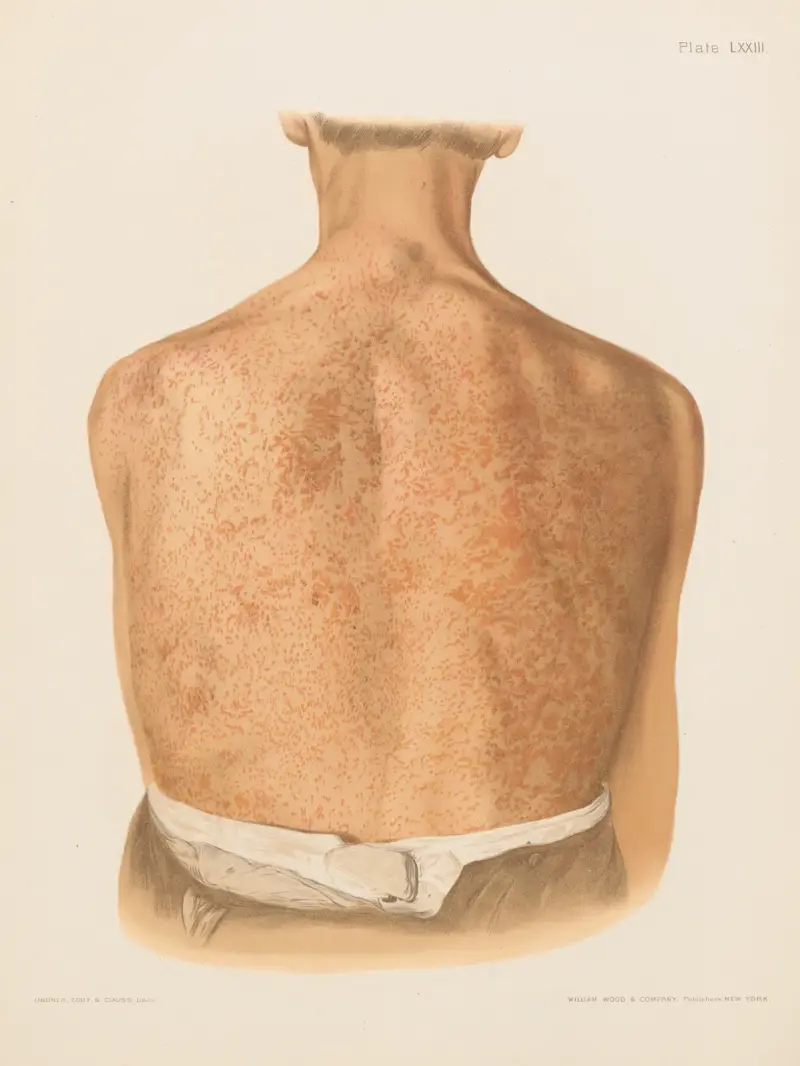 Chromophytosis, Prince Albert Morrow