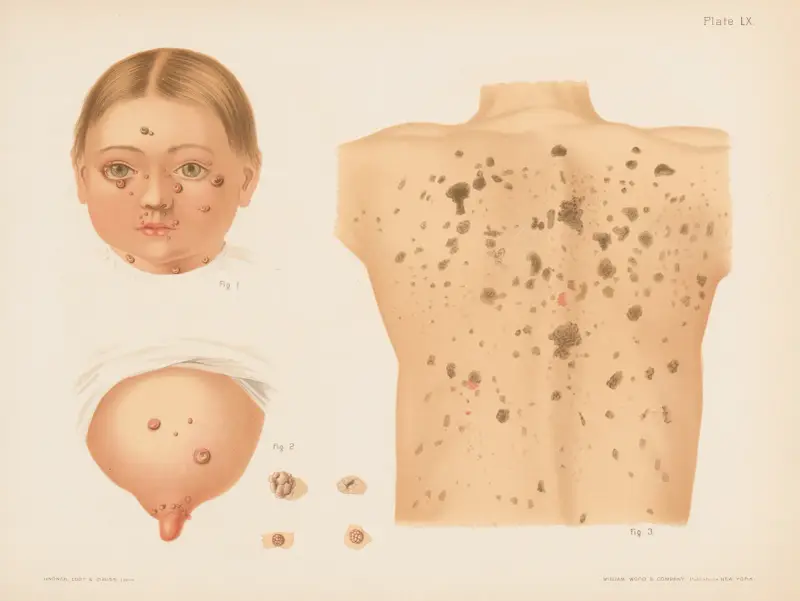 I. och II. Molluscum epitheliale, III. Verruca senilis av Prince Albert Morrow