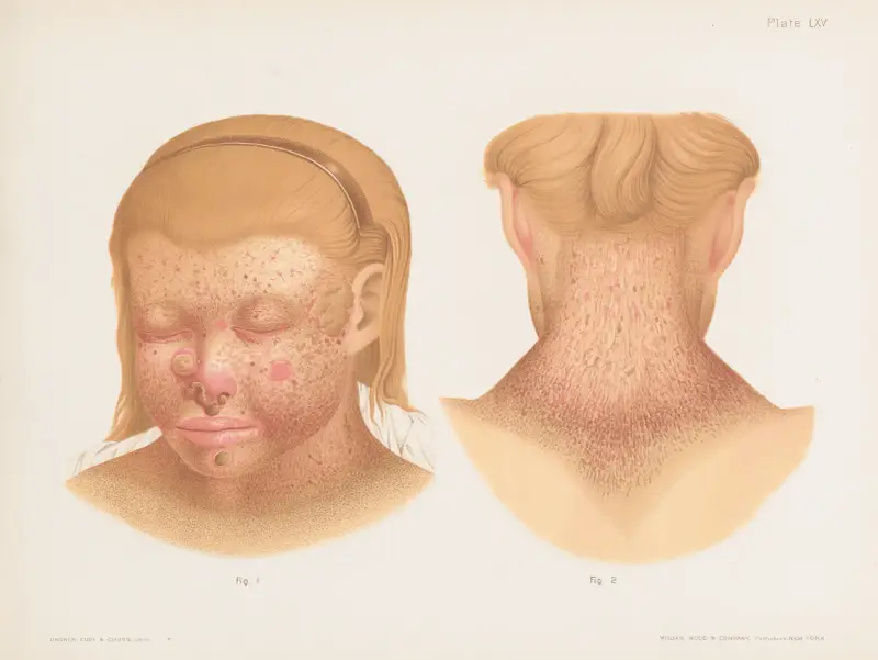 I. i II. Xeroderma pigmentosum, Prince Albert Morrow