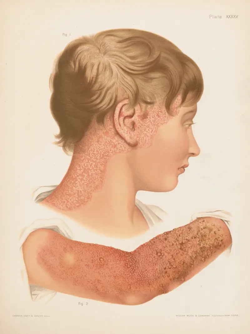 I. Eczema squamosum, II. Eczema papulosum, vesiculosum et impetiginosum, Prince Albert Morrow