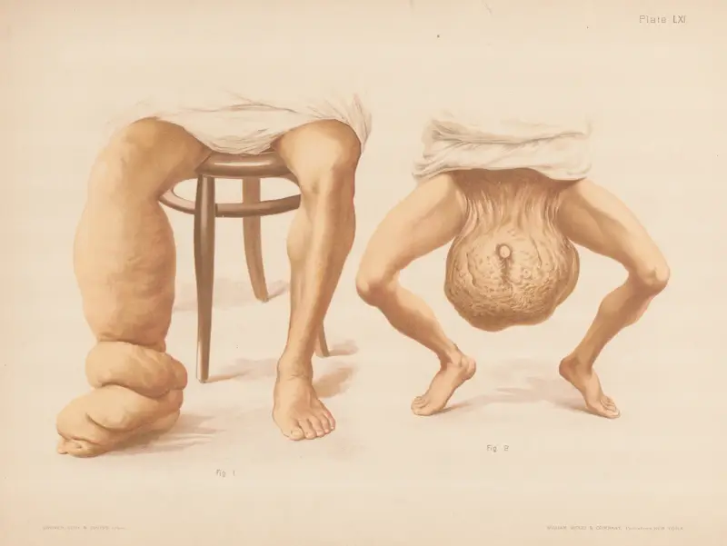 I. Elephantiasis des Beins, II. Elephantiasis des Hodensacks von Prince Albert Morrow