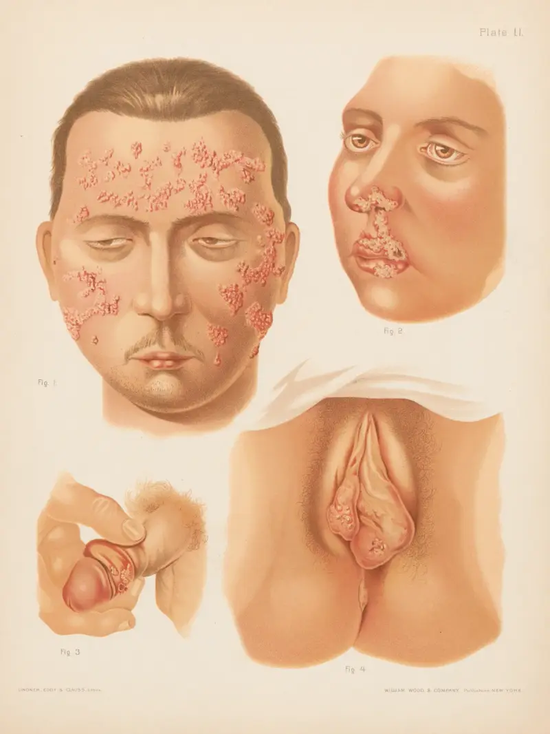 I. Herpes zoster (dubbelsidig), II. Herpes febrilis, III. Herpes på manliga könsorgan, IV. Herpes på kvinnliga könsorgan av Prince Albert Morrow