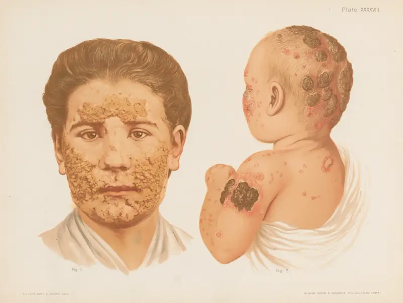 I. Impetigo figurata, II. Impetigo contagiosa av Prince Albert Morrow