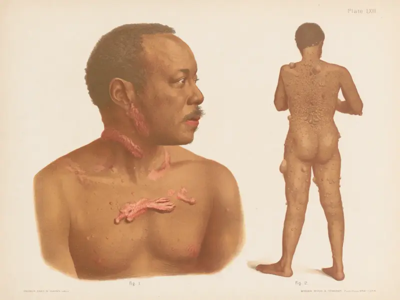 I. Keloid, II. Fibroma av Prince Albert Morrow
