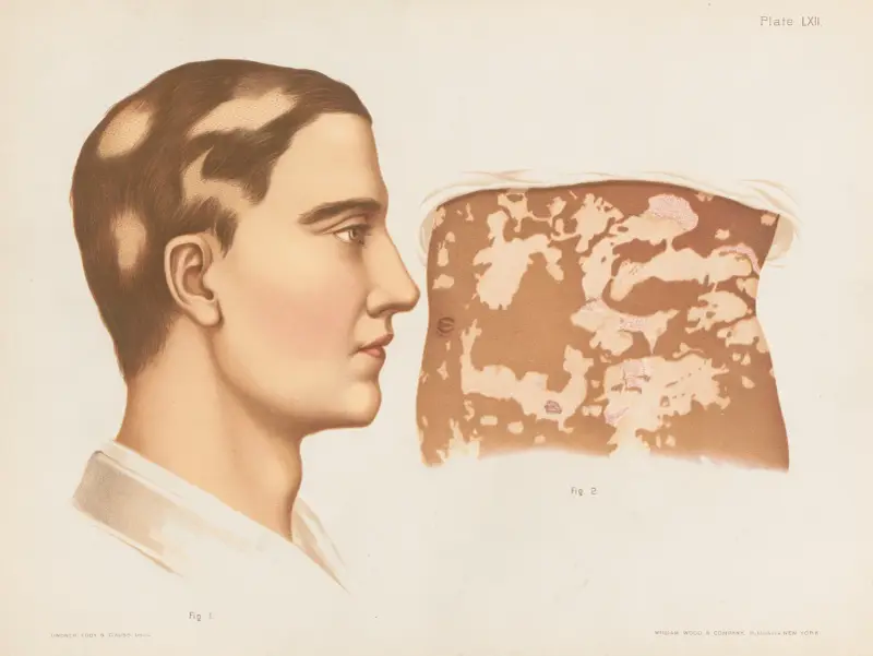 I. Leucoderma, II. Alopecia areata von Prince Albert Morrow