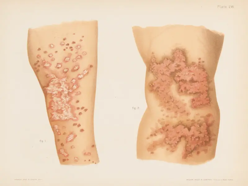 I. Lichen planus, II. Lichen planus av Prince Albert Morrow