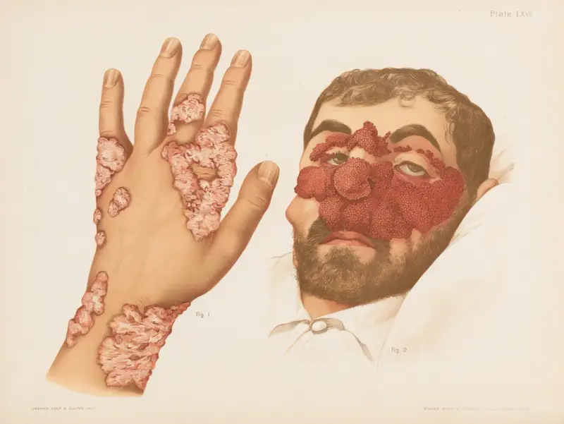 I. Lupus Papillaris, II. Tuberculosis Papillomatosa Cutis av Prince Albert Morrow
