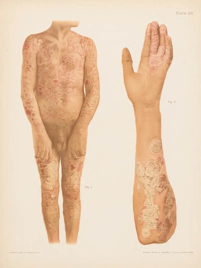 I. Psoriasis på kroppen, II. Psoriasis på hand och arm av Prince Albert Morrow