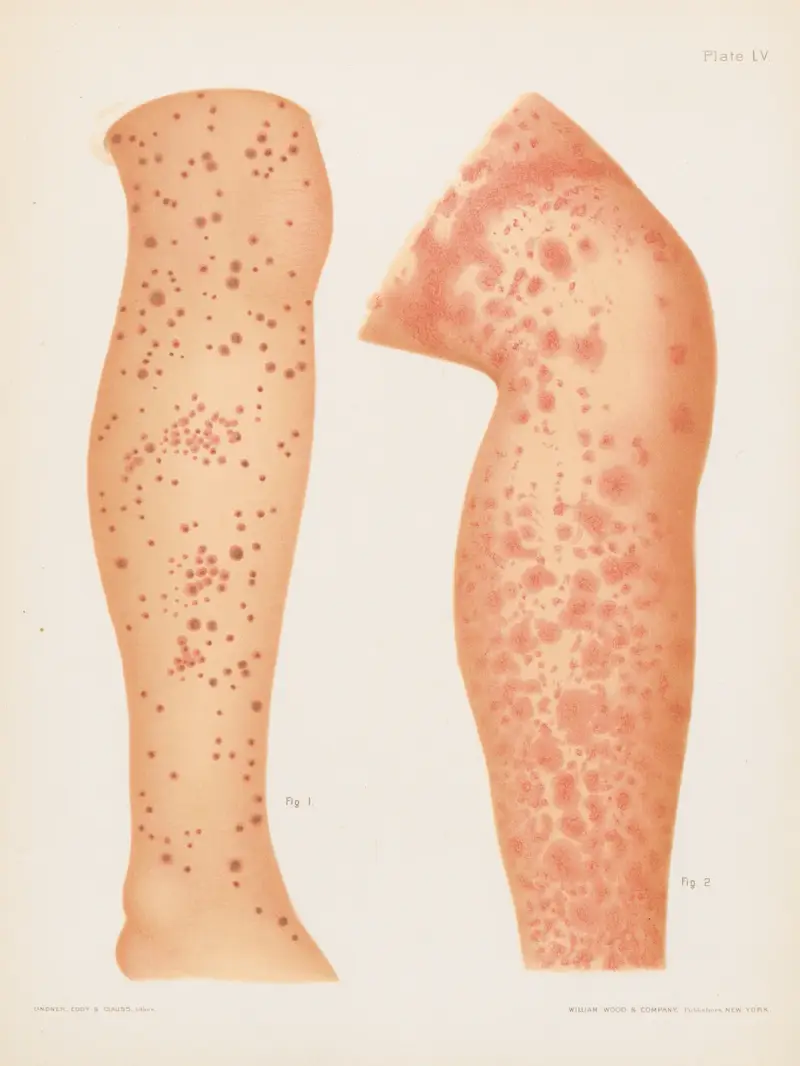 I. Purpura simplex, II. Purpura thrombotica av Prince Albert Morrow