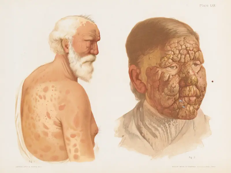 I. Tuberkulöse Lepra mit fleckförmigen Läsionen, II. Tuberkulöse Lepra von Prince Albert Morrow
