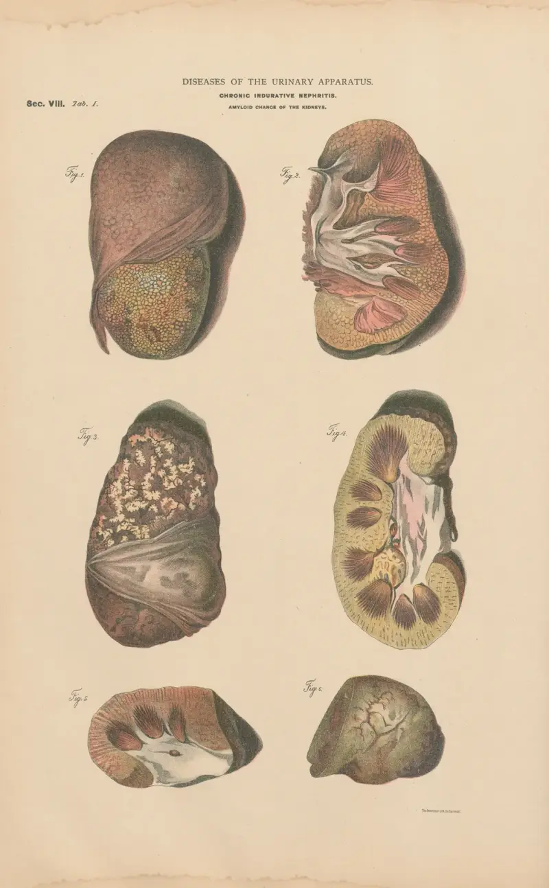 Chronic Nephritis and induration av Jean Allard Jeancon
