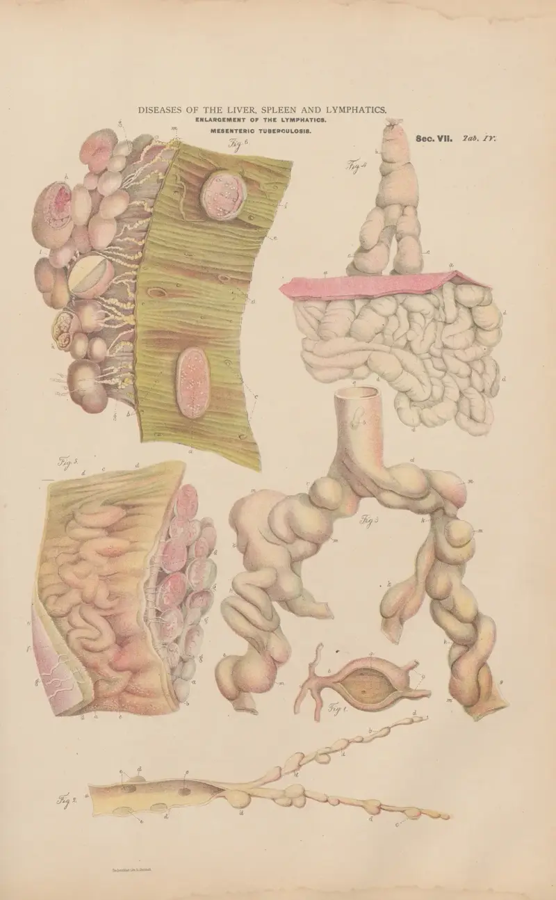 Dilatation and hypertrophy of thoracic duct av Jean Allard Jeancon