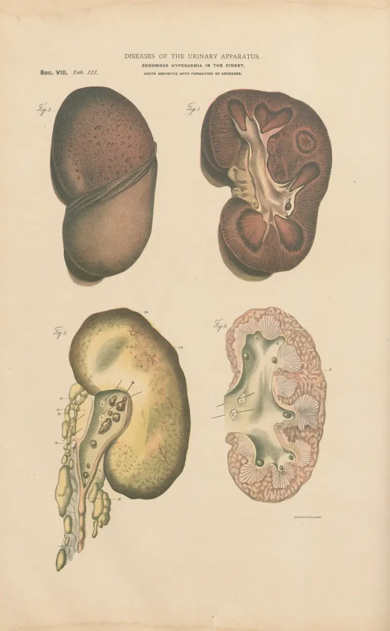 Hyperæmia and enlargement of kidney av Jean Allard Jeancon