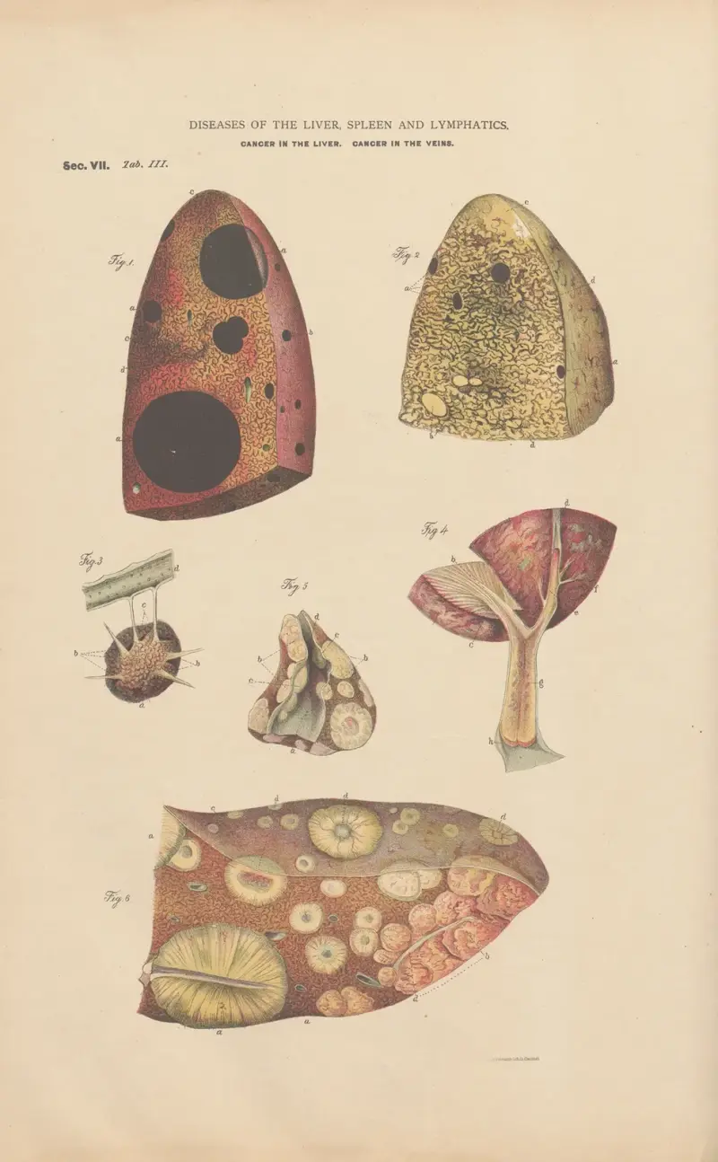 Melanosis of the liver, carcinomata av Jean Allard Jeancon