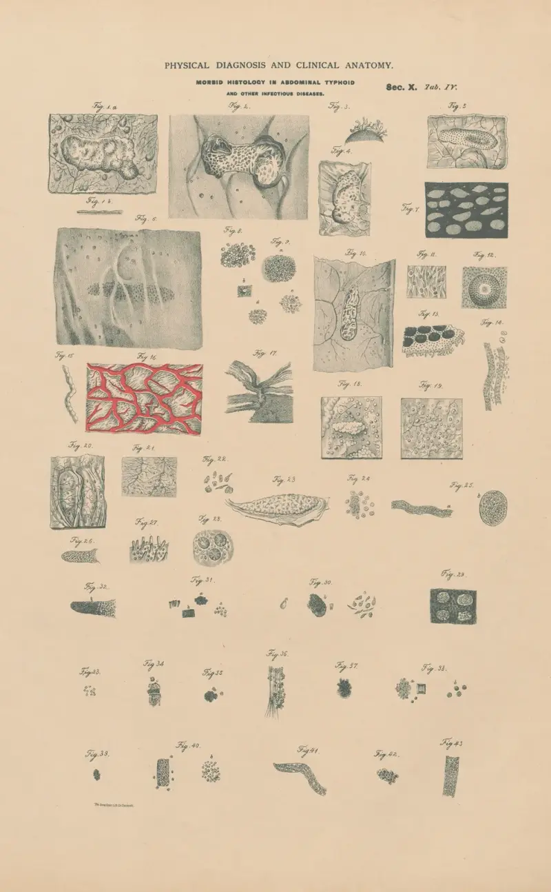 Morbid histologi vid tyfoidfeber i buken, scharlakansfeber. Tuberkulos, gangrän m.m. av Jean Allard Jeancon