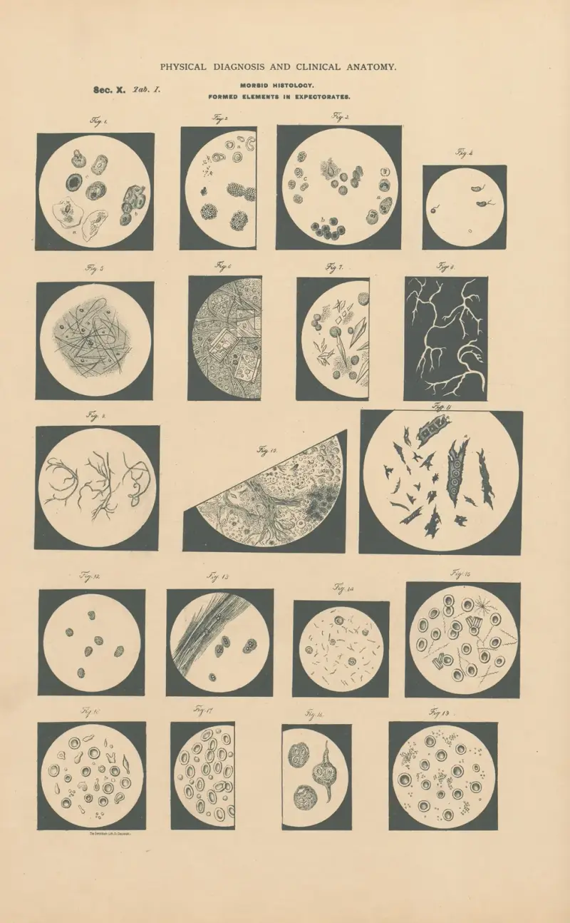 Morphologische Bestandteile im Auswurf von Jean Allard Jeancon