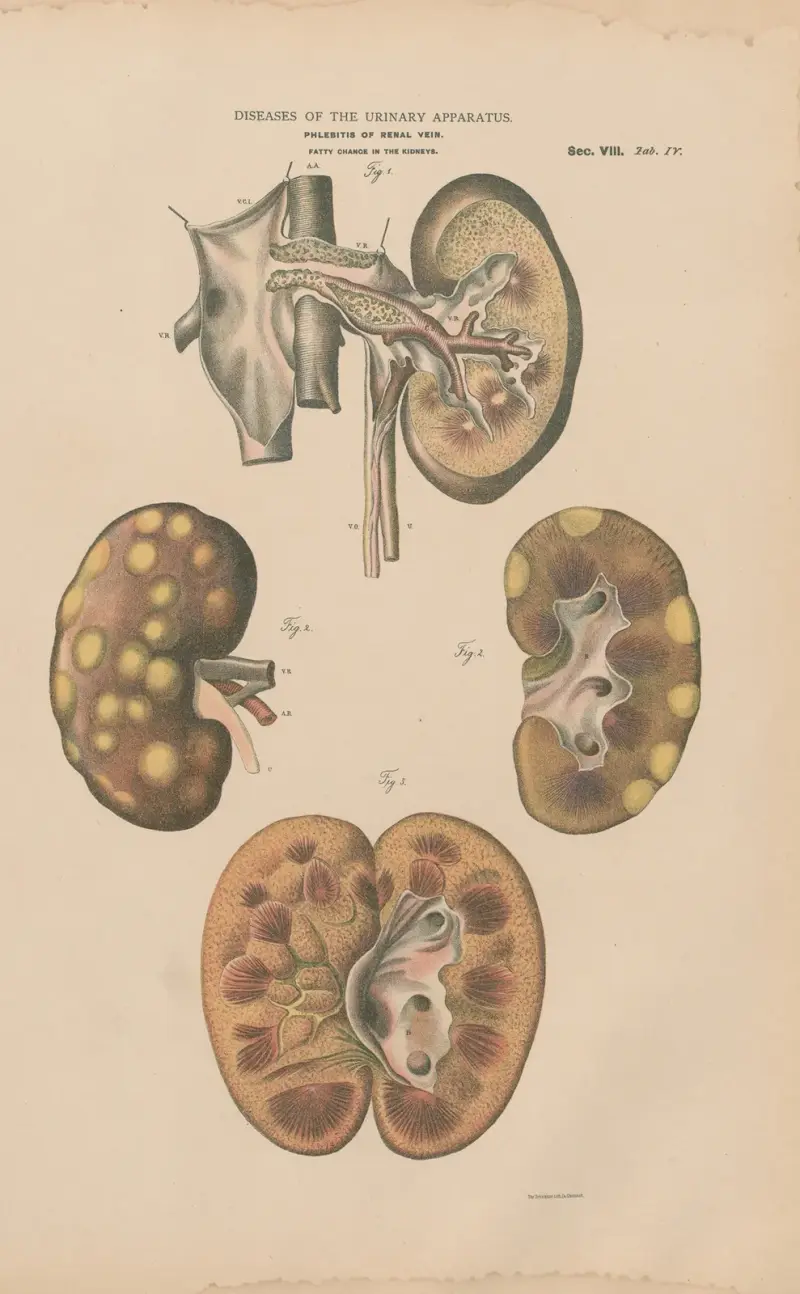 Phlebitis of renal vein. Fatty change av Jean Allard Jeancon